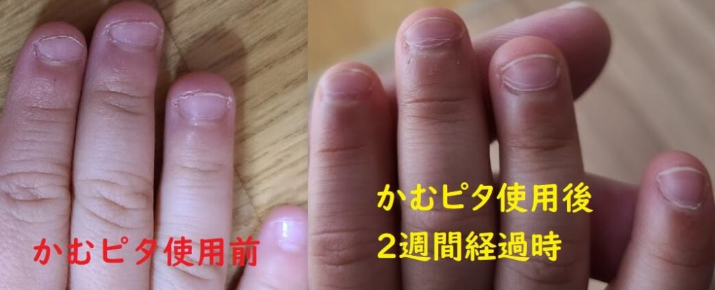 男子小学生 爪噛み ブログ 子供の爪噛みに悩むママが「かむピタ」を実際に試してみた【感想・レビュー】 – 双子ママの育児を楽しむアイディア箱
